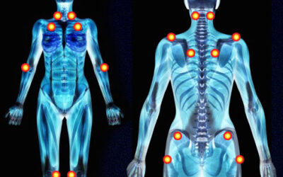 Does Craniosacral Help with Symptoms of Fibromyalgia? By Sharon Hartnett