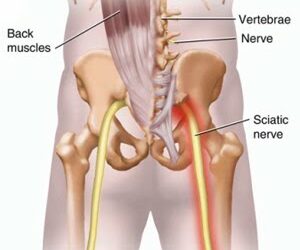 Help for Sciatic Pain