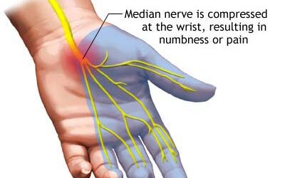 Carpal Tunnel Syndrome