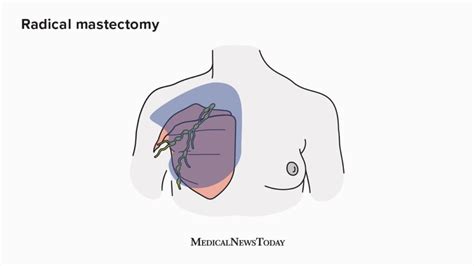 Unlocking the Healing Energy of Your Heart After a Masectomy